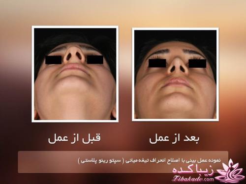 جراحی بینی - جراحی زیبایی